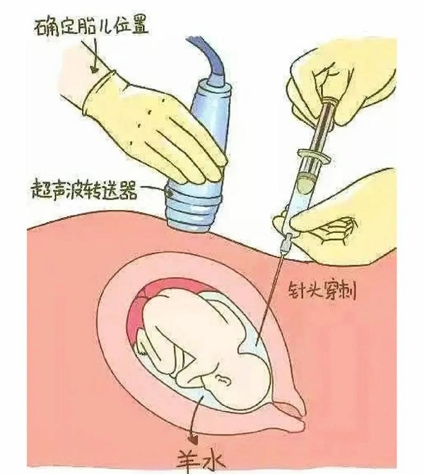 怀二胎时能做亲子鉴定吗？无创检测和羊水穿刺对比