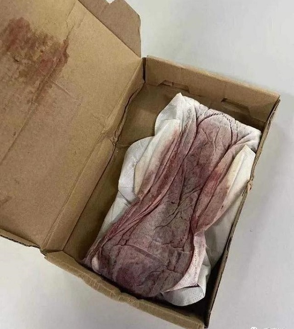 卫生巾上的血能做亲子鉴定吗？特殊样本检测可能性